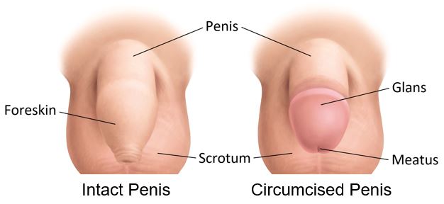 circumcicion